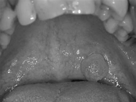 Oral squamous cell papilloma (SCP) of the palate. | Download Scientific ...