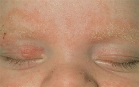 Seborrhoeic dermatitis: Symptoms, causes and treatment | Bupa UK