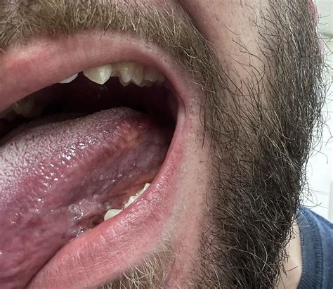 Burning foliate papillae : r/dentists_ask
