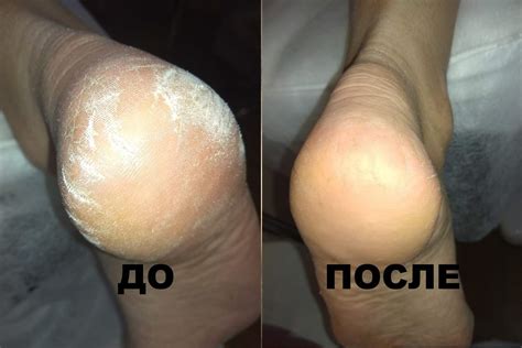 Натоптыши на ногах, лечение натоптышей на ступнях, удалить натоптыши на ...