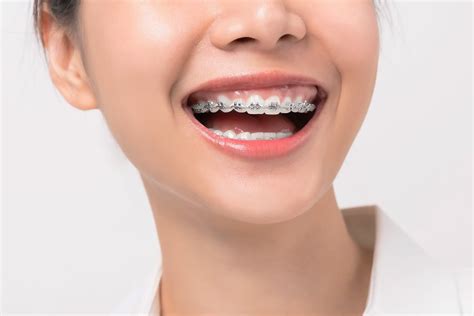 teeth braces braces cost  price kl dental