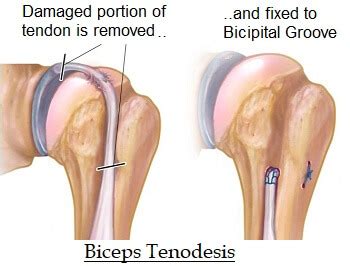 Biceps Tendonitis: Causes, Symptoms & Treatment