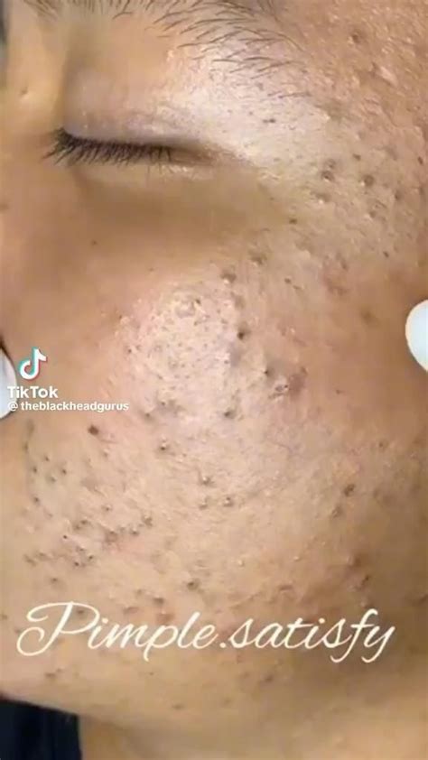 This 2024 Blackhead Removal Method Changed My Life (Seriously!) - 8z5ds0j