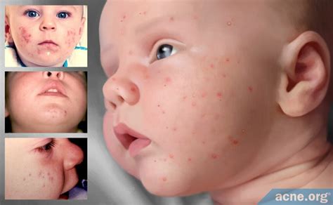 Everything about Acne & Scars - Acne.org