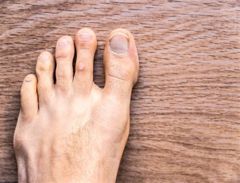 Брадавици: видове и лечение | DR—DENKOVA DERMATOLOGY