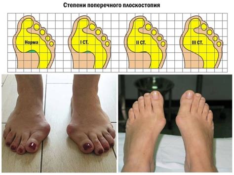 Как выглядит плоскостопие 3 степени: Плоскостопие 3 степени