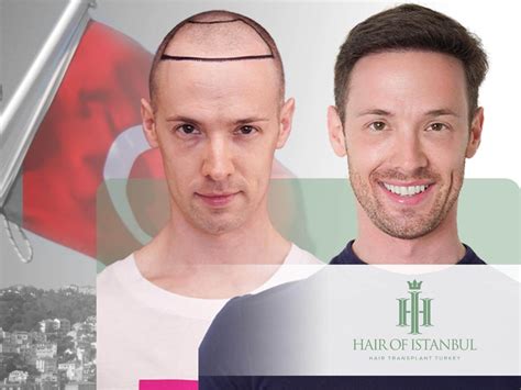 shaped hairline  ultimate guide  understanding