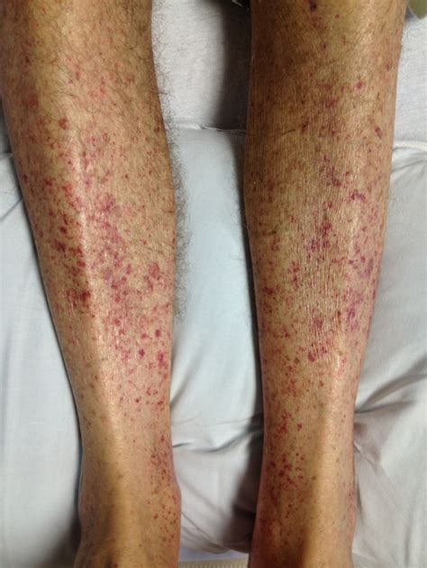 Itchy Skin Causing Petechiae at Edward Criss blog