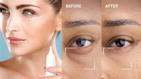 eye creams  dark circles  effective results