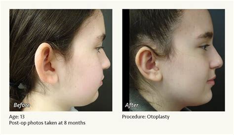 Otoplasty | Ear Pinning Surgery in Plano & Dallas, TX | Ronald Friedman, M.D.