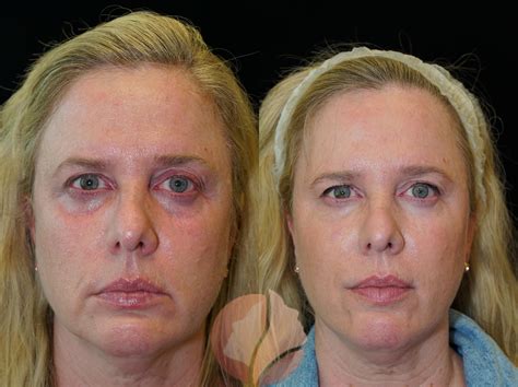 botox  dermal filler
