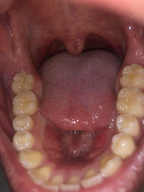 Swollen gum behind second molar, no wisdom tooth (x-rayed). Is this