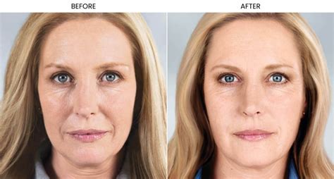 surgical facelift options