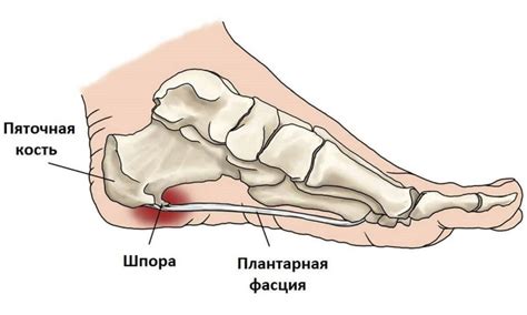 Пяточные шпоры: лечение, симптомы, причины