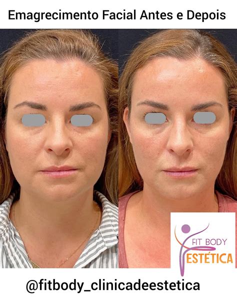 Emptiers Antes E Depois - Emagrecimento Facial Antes e Depois - Emptiers Facial