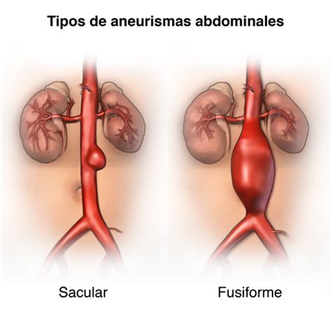 Abdominal Aortic Aneurysm