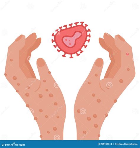 Monkeypox Cell Virus Icon. Health Monkey Pox Emergency. Viral Dangerous