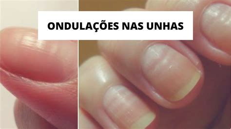 Unhas Com Ondulações O Que Pode Ser - O QUE CAUSA ONDULAÇÕES NAS UNHAS | #rafatododia - YouTube