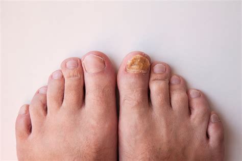 The Shocking Consequences of Having Untreated Toenail Fungus for Too L