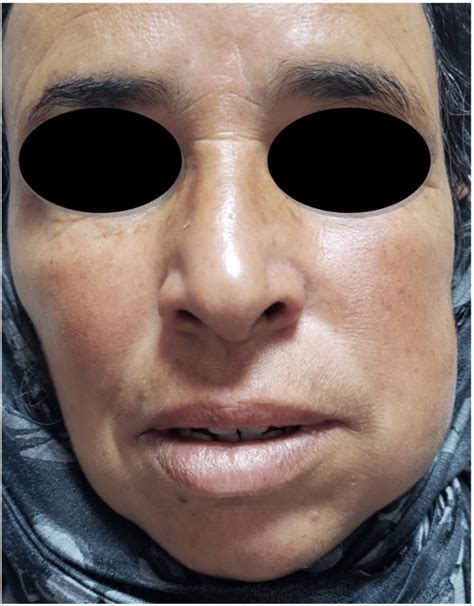 Preoperative external presentation of left cheek swelling. | Download ...