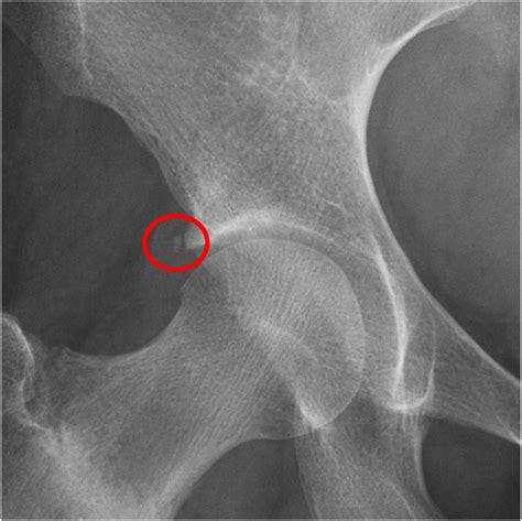 Acetabular Rim Ossification Variants Are Found in Almost 20% of ...