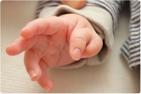 Incidence of Polydactyly