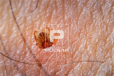 Carrapato Dentro Da Pele Humana - Detalhe de carrapato-estrela na pele humana - também denominado ...