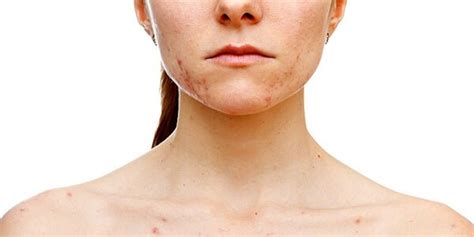 Spots, Moles, and Stretch Marks: Normal Skin Doesn't Make the Adverts