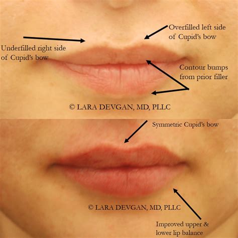 how to get rid of a bump on lip