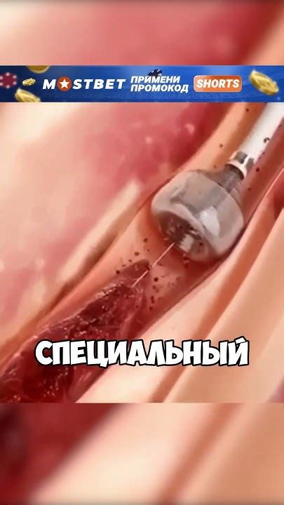 Как происходит удаление Тромба 🤯 - YouTube