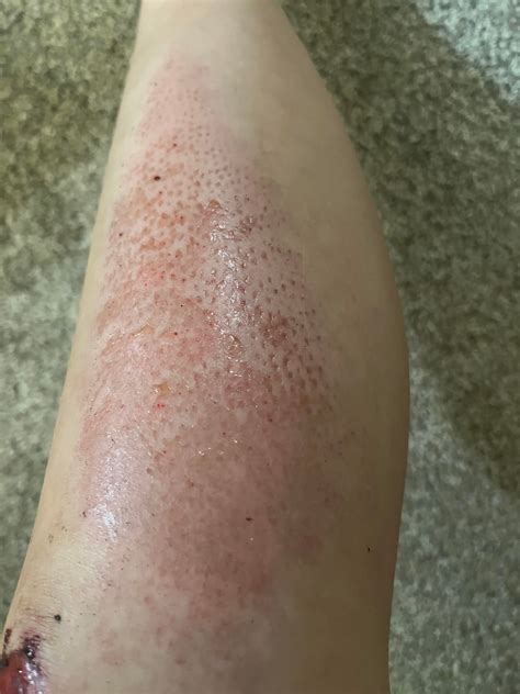 Holes In Skin Disease