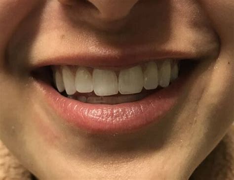 Before & After Lip Fillers Bellaire | Face Forward