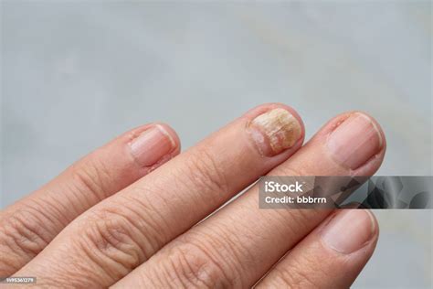 Hand Finger Nail With Fungal Infection Stock Photo - Download Image Now ...