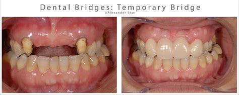 Dental Bridges by Seattle Expert Dentist. Teeth Replacement. Shor Dental