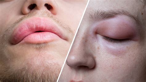 Angioedema
