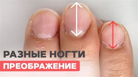 Ногти для медсестры | Исправляем разные ногти | Наращивание - YouTube