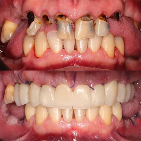 Affordable and Reliable: The Best Dental Implants in Colombia - Dental