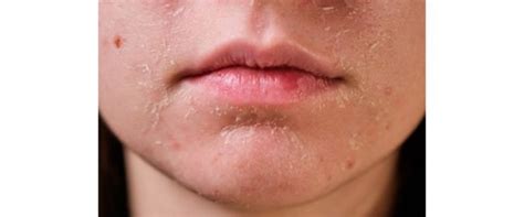 bukan pakai madu   atasi kulit wajah kering  mengelupas