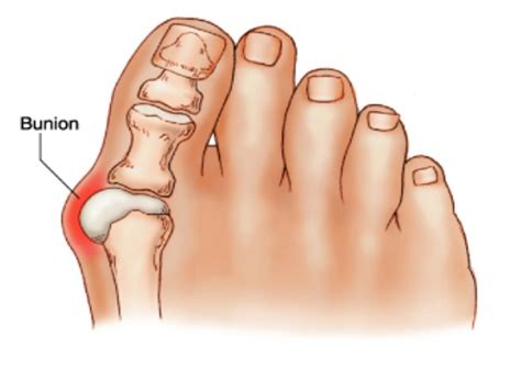 Bunions | Coquitlam Podiatry Foot and Ankle Clinic Coquitlam, Vancouver ...