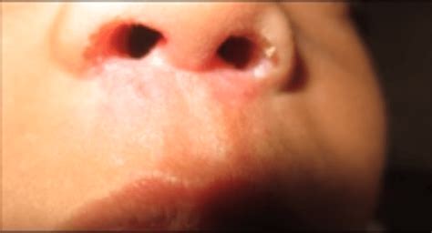 Nasal vestibulitis causes, symptoms, complications and treatment