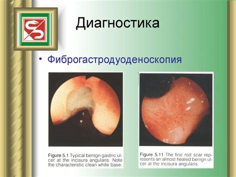 Хирургическое лечение язв желудка и двенадцатиперстной кишки ...