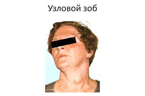 Узловой зоб: причины, симптомы, диагностика и лечение