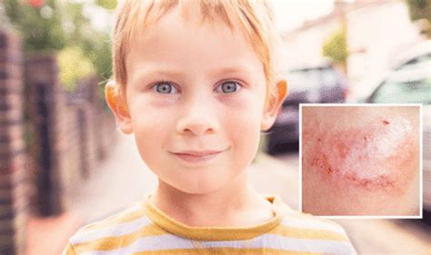 Slapped cheek syndrome: Symptoms include distinctive facial rash | Express.co.uk