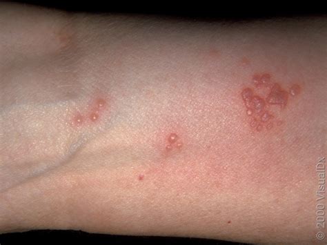 shingles rash   stages  pictures goodrx