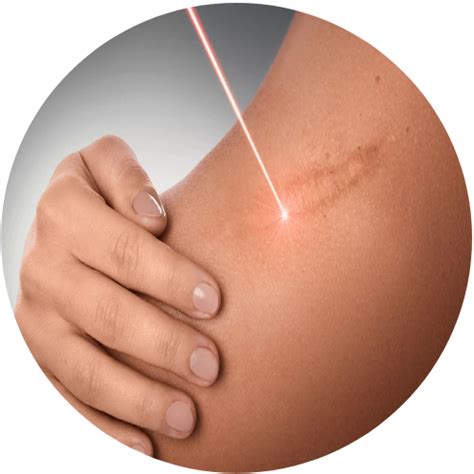 scar removal linda alfieri hair replacement center full service salon