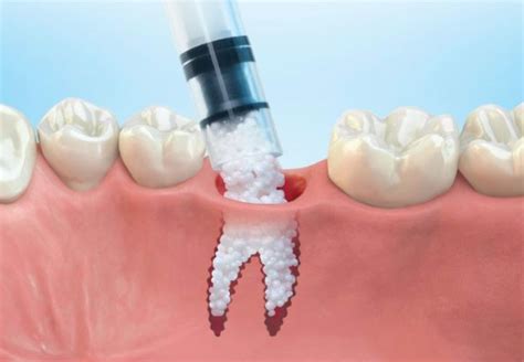 bone grafting  dental implants periodontist  birmingham al