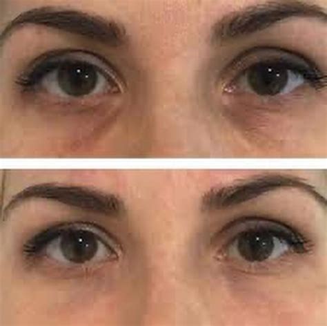 MesoEye C71 - Cyprus Dermatology Clinic