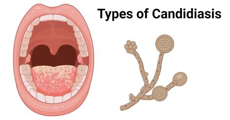 types  candidiasis  transmission  pathogenesis microbe notes