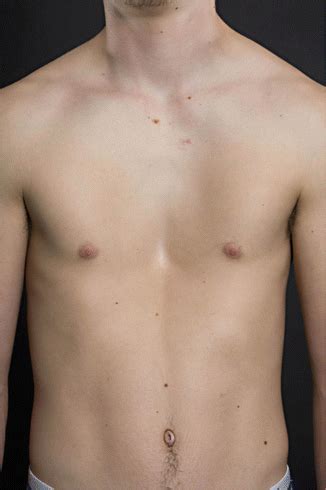 Pectus Excavatum | Thoracic Key