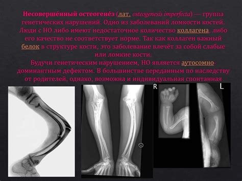 Несоверше́нный остеогене́з - презентация онлайн